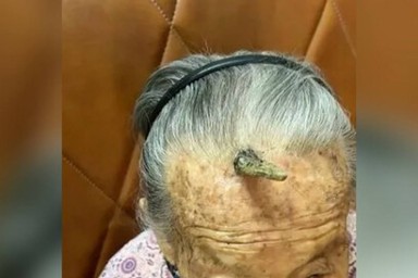 Почти столетняяя китаянка чуть не погибла, отрезав себе «рог долгожителя»