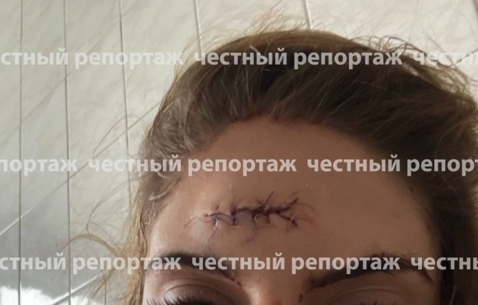 Сотрясение и перелом: в Башкирии «неприличную женщину» столкнули с лестницы