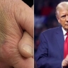 Daily Beast: Трамп скрывает гематомы под тональным кремом