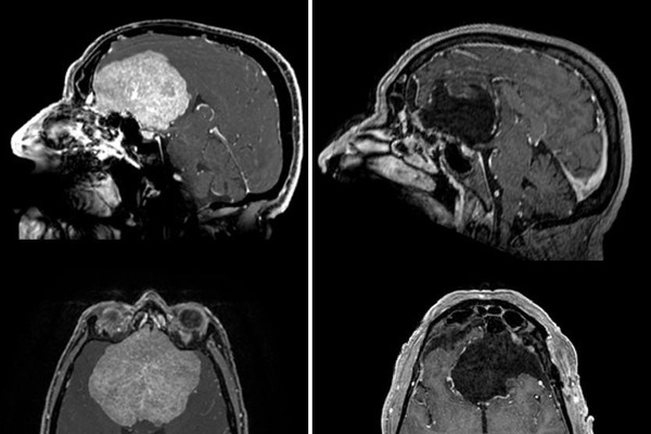 В Москве хирурги удалили мужчине гигантскую опухоль мозга