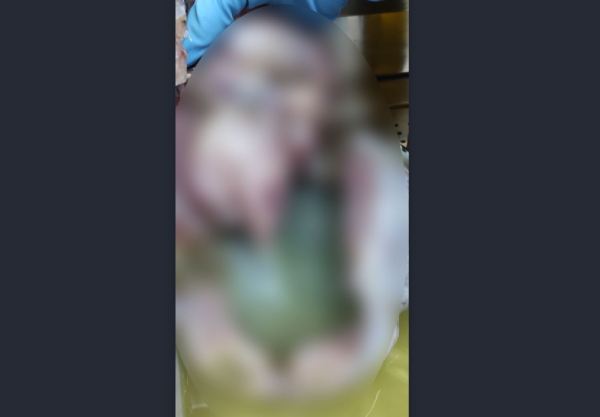 В Бурятии врачи удалили огромную кисту яичника
