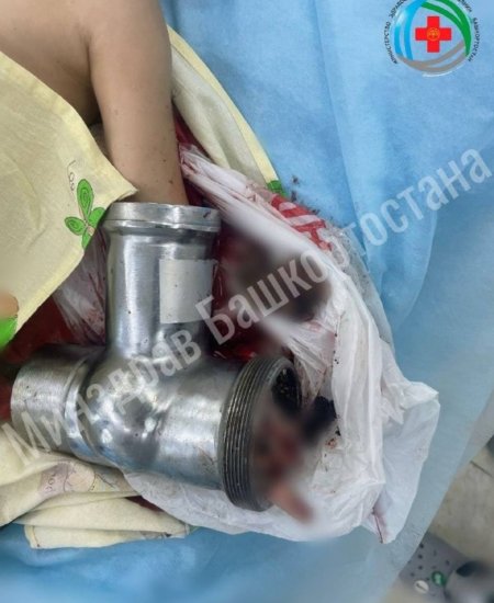 Девочка в Башкирии пострадала от электромясорубки