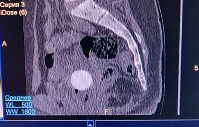 В Кирове врачи достали из 11-летней девочки каучуковый мячик В Кирове врачи достали из 11-летней девочки каучуковый мячик