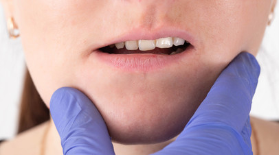 Ортодонт Радько: неправильный прикус может стать причиной развития гайморита Ортодонт Радько: неправильный прикус может стать причиной развития гайморита