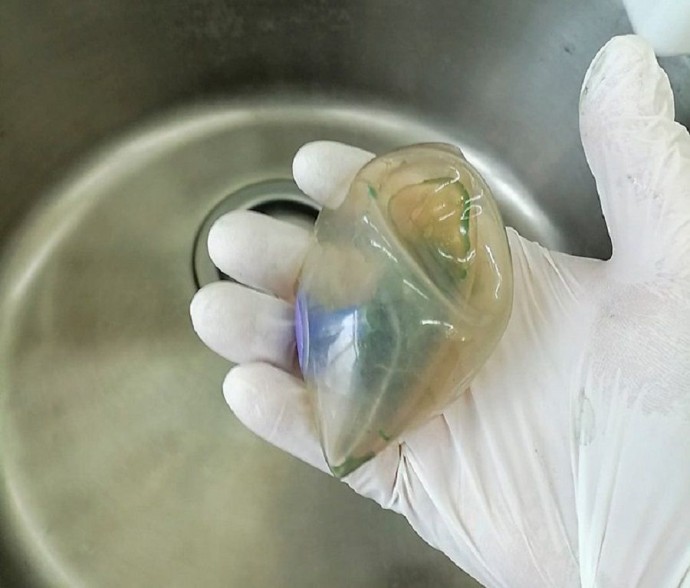 Врачи из Находки спасли пациентку с силиконовым шаром в желудке Врачи из Находки спасли пациентку с силиконовым шаром в желудке