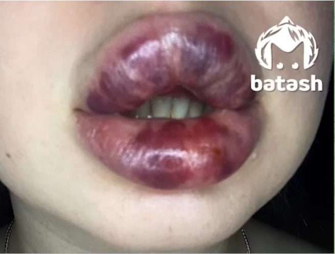 Жуткий «подарок» к Новому году: уфимке в клинике изуродовали губы