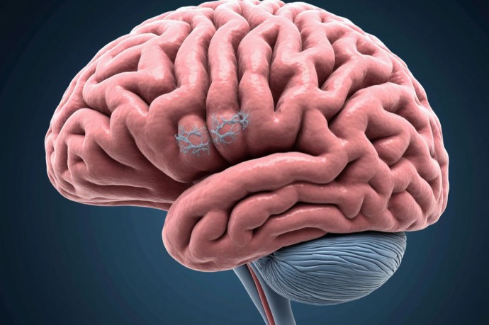 В Новосибирске нашли способ подавлять агрессивную опухоль мозга В Новосибирске нашли способ подавлять агрессивную опухоль мозга