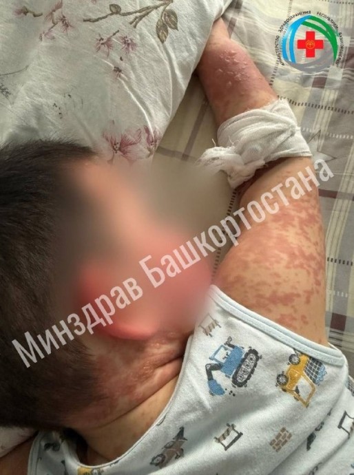 В Уфе спасли малыша с редким синдромом «ошпаренной кожи»