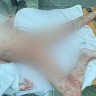 В Липецкой области врачи спасли 4-летнюю девочку после ожогов борщевиком