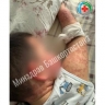 В Уфе врачи спасли малыша с синдромом «ошпаренной кожи»