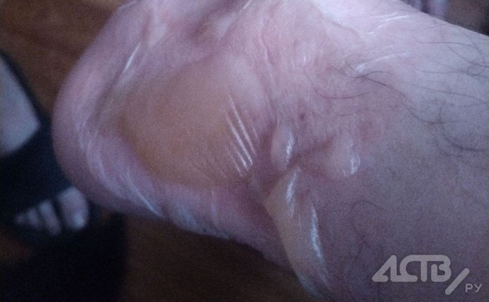 Прокуратура начала проверку после инцидента с ожогом в Южно-Сахалинске