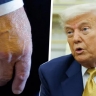 Врачи диагностировали у Трампа хроническое заболевание вен, заметив отёки на ногах и синяки на руках