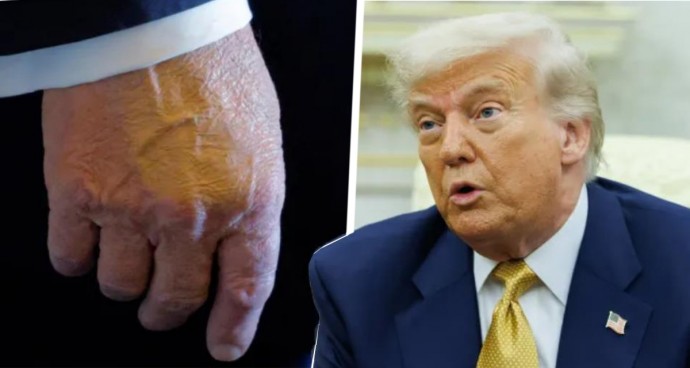 Врачи диагностировали у Трампа хроническое заболевание вен, заметив отёки на ногах и синяки на руках