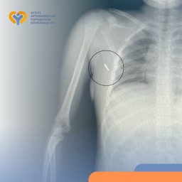 Приморские врачи спасли девочку, в которую воткнулся ртутный градусник