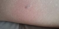 20 тысяч за испуг и укусы: астраханские прокуроры наказали рублем чиновников за нападение собаки