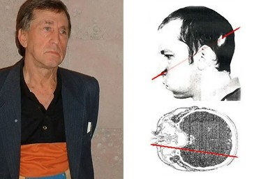 Человек с застывшим лицом: 47 лет после луча смерти