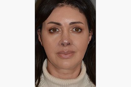 Хирург показал новые фото экс-жены Аршавина после курса по восстановлению носа Хирург показал новые фото экс-жены Аршавина после курса по восстановлению носа