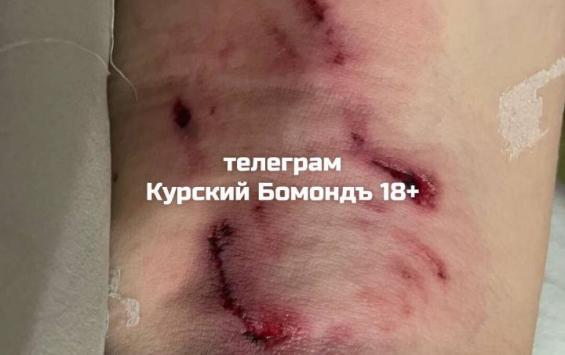 В Курске следователи начали проверку после сообщения о нападении собаки на школьника