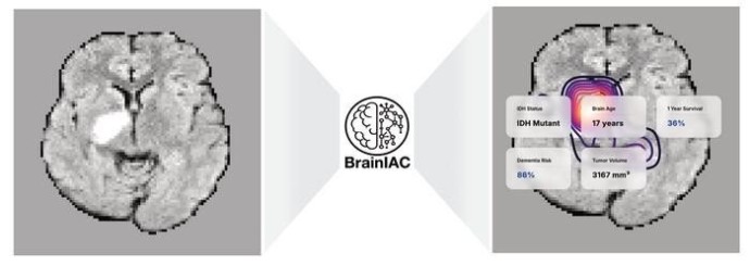 Искусственный интеллект BrainIAC: прорыв в прогнозировании выживаемости при онкологии
