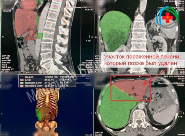 Врачи в Башкирии «нарастили» пациенту новую печень Врачи в Башкирии «нарастили» пациенту новую печень