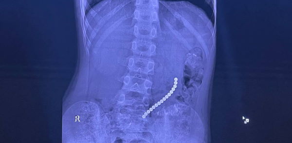 В Иркутске врачи спасли ребёнка, проглотившего 16 шариковых магнитов