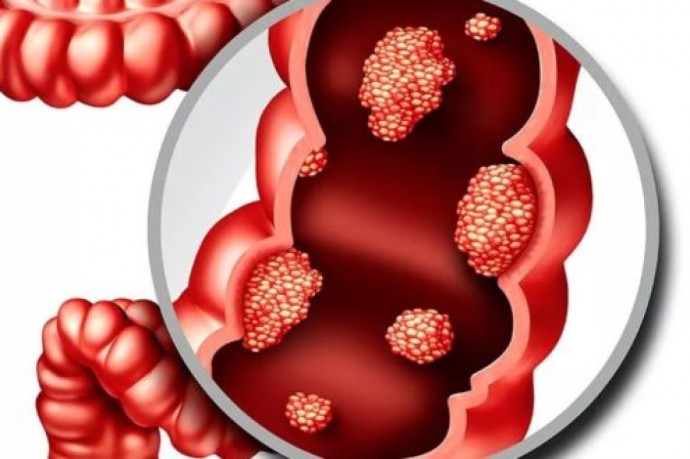 Новый метод диагностики рака толстой кишки снижает риск смерти