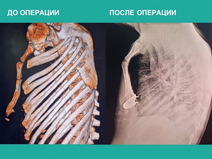 Кировские врачи исправили деформированную грудную клетку подростка