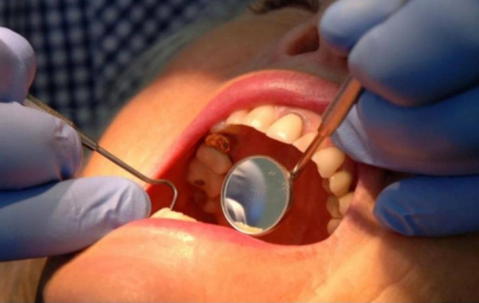 Британские ученые заявляют, что победили кариес - в следующем году гель поступит в продажу Британские ученые заявляют, что победили кариес - в следующем году гель поступит в продажу